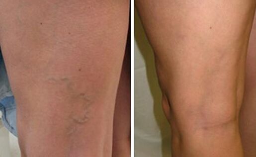 Neoveris helped prevent further development of varicose veins