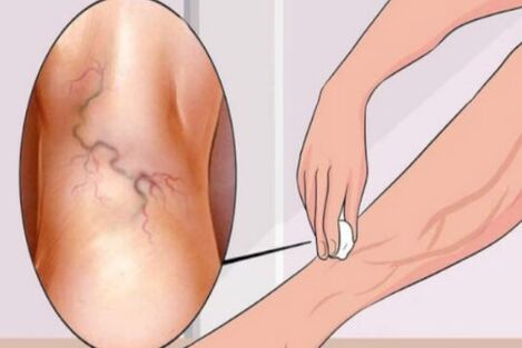 Varicose veins