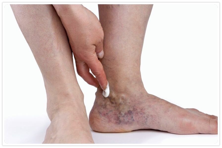 The benefits of the procedure to the veins