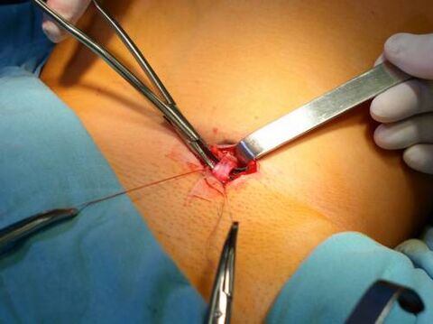 Flebectomy