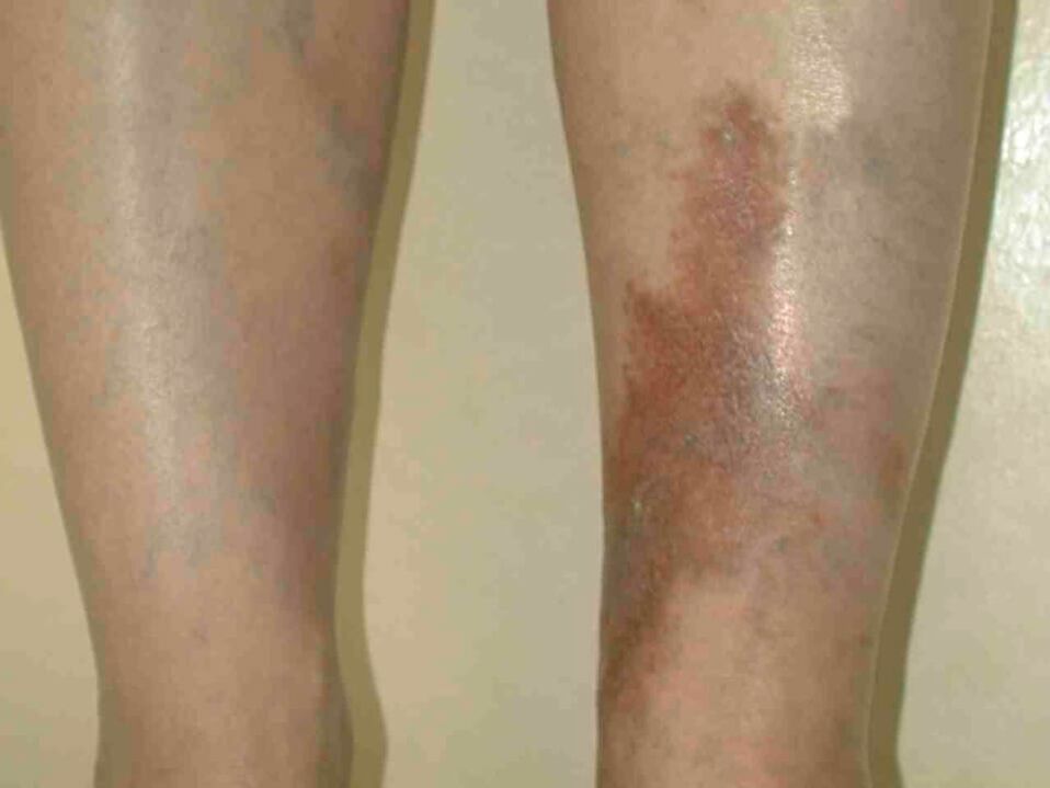 Stages of varicose veins