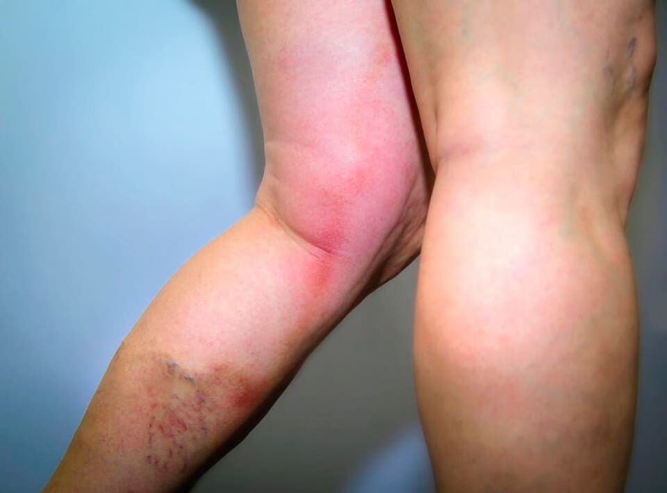 The consequences of varicose veins
