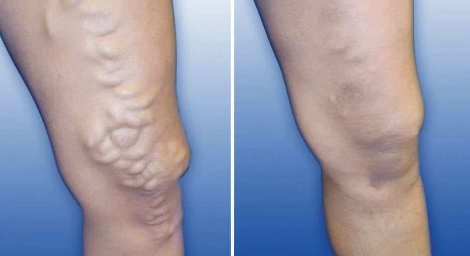 The degree of varicose veins