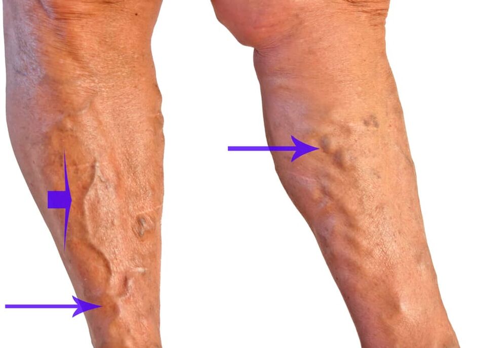 varicose nodes