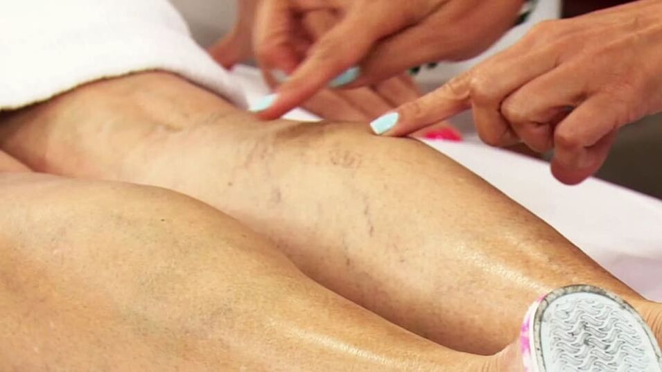 varicose veins at the bottom of the leg