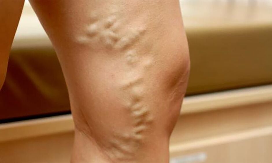 varicose veins in the leg