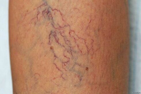 Why are varicose veins dangerous