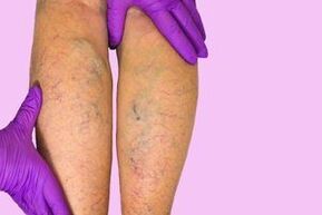 Varicose veins in the legs.