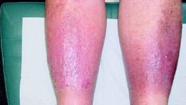 third stage of varicose veins in the legs