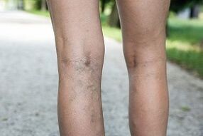 Manifestations of varicose veins in the legs.