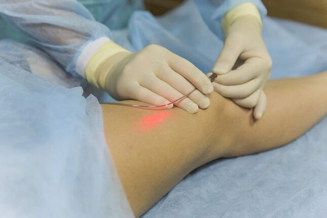Laser treatment of varicose veins.