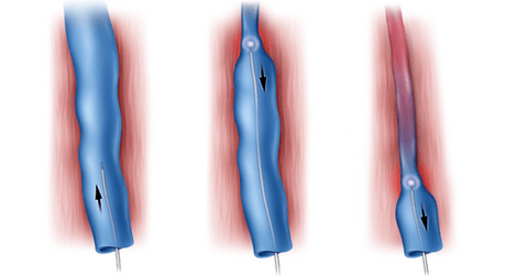 Radiofrequency ablation is a method of treating varicose veins.