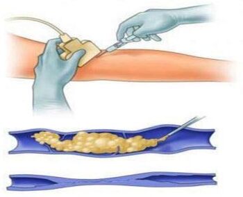 Sclerotherapy is a method of treating varicose veins.