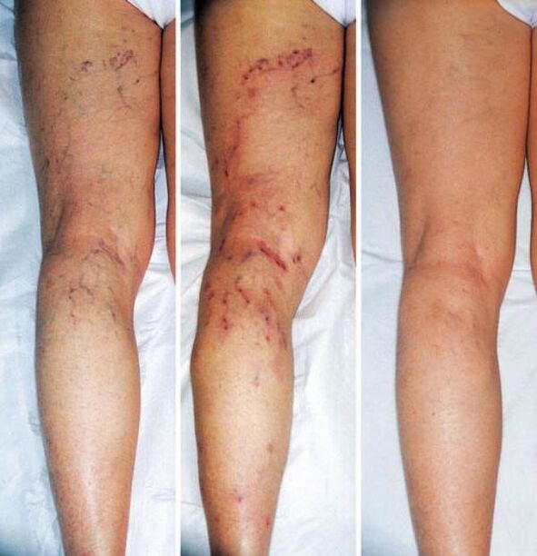 Stages of varicose veins of the lower extremities.