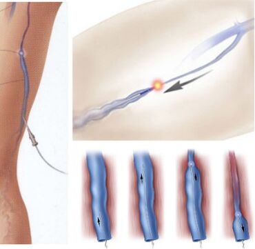 varicose vein treatment method endovenous laser coagulation