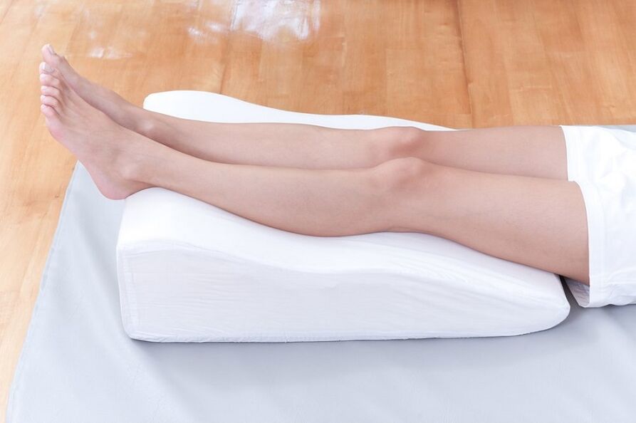 varicose veins in the legs