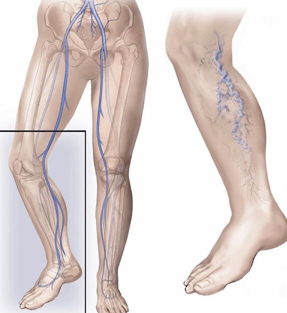 Healthy veins and veins affected by varicose veins.
