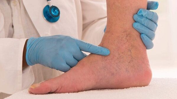 doctor examining legs with varicose veins