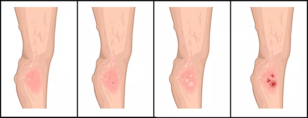 Stages of development of trophic ulcers in venous pathology. 