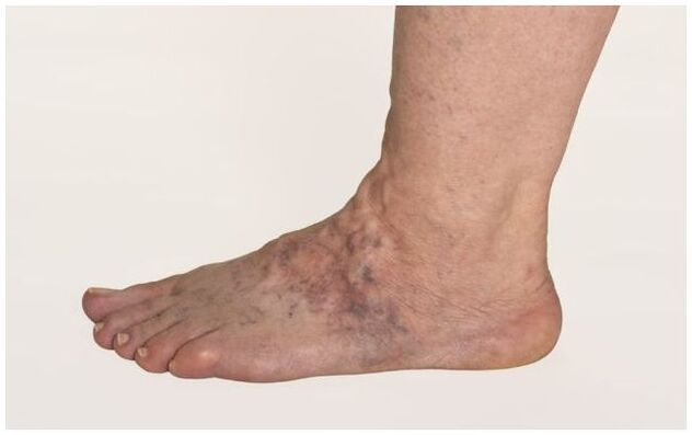 Varicose veins on the leg of a man, complicated with trophic ulcers