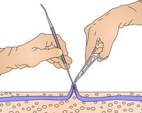 Miniphlebectomy removal of the part of the vein affected by varicose veins