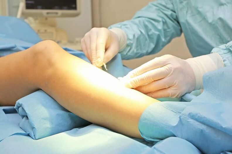 Surgery to remove varicose veins