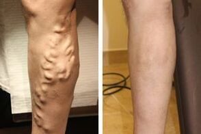 The result of the operation to remove varicose veins on the legs. 