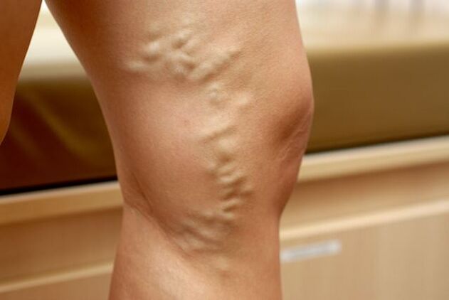 Deformed vein protruding on the leg with stage 3 varicose veins