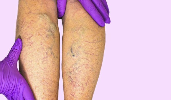 Varicose veins in the legs