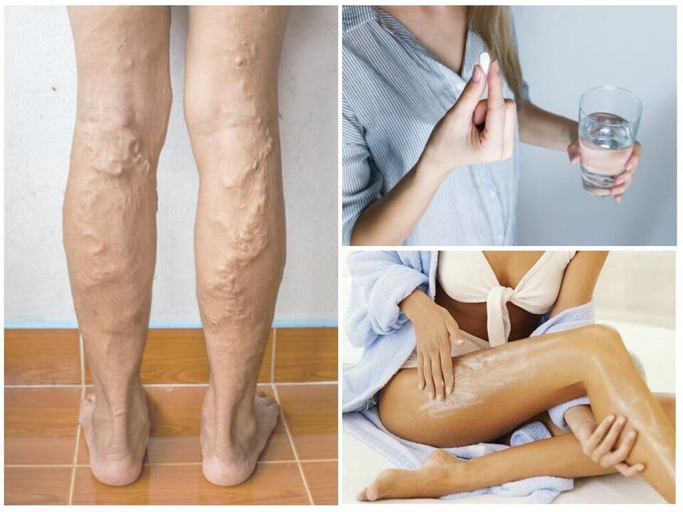 Varicose veins of the lower extremities and methods for their treatment. 