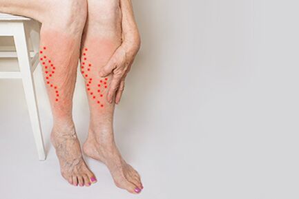 Burning and heaviness in the legs - symptoms of varicose veins