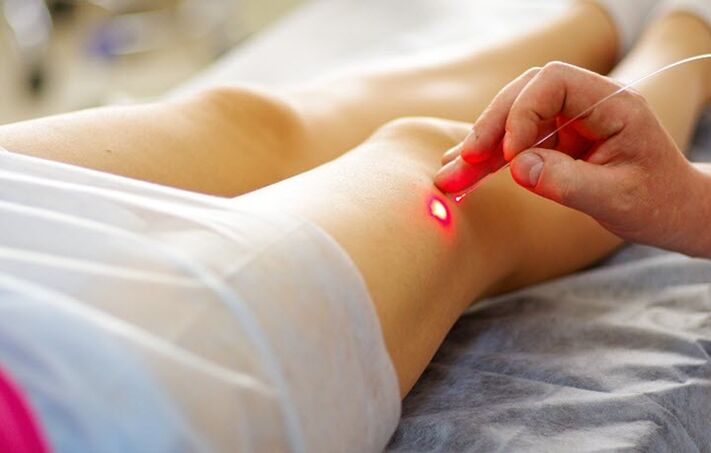 Laser method to treat varicose veins. 